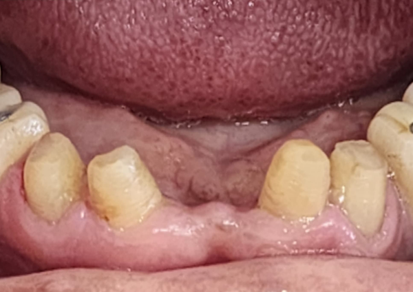 Crowns & Bridges - Before